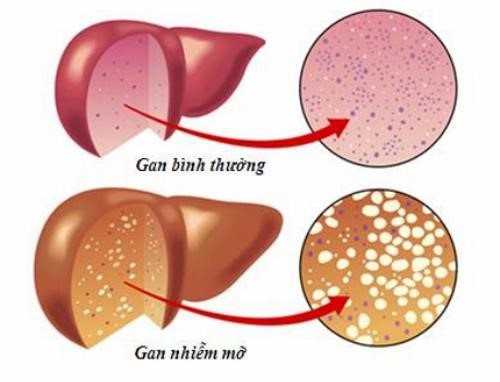 Hình ảnh gan bị nhiễm mỡ so với gan bình thường